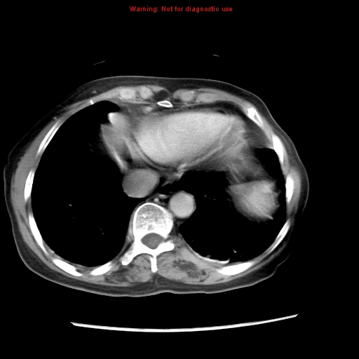 Adenocarcinoma of the colon (Radiopaedia 8191-9039 Axial liver window 10).jpg