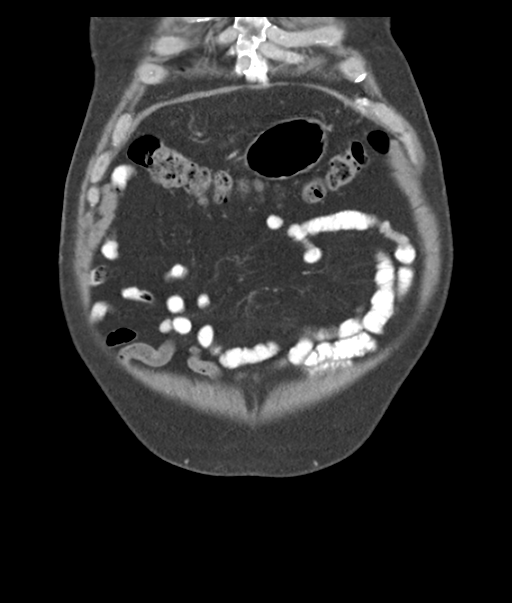 Adenocarcioma of rectum- T1 lesion (Radiopaedia 36921-38547 Coronal C+ portal venous phase 11).png