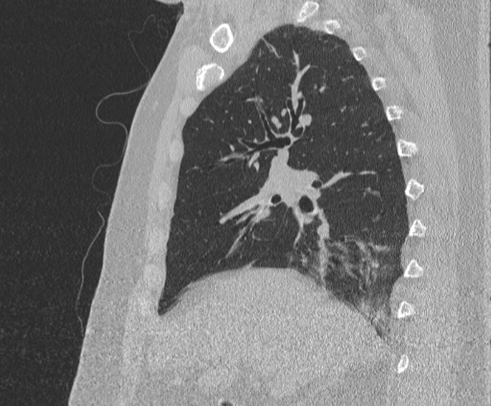 Adenoid cystic carcinoma of the trachea (Radiopaedia 49042-54137 Sagittal lung window 175).jpg
