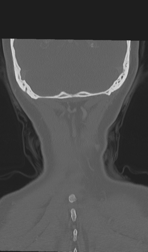 Adenoid cystic tumor of palate (Radiopaedia 46980-51518 Coronal bone window 54).png