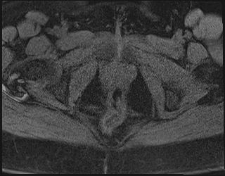 File:Adnexal multilocular cyst (O-RADS US 3. O-RADS MRI 3) (Radiopaedia 87426-103754 Axial 212).jpeg