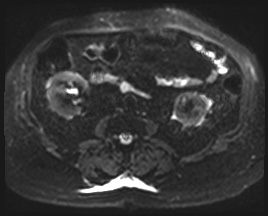 Adrenal cortical carcinoma (Radiopaedia 64017-72770 Axial DWI 33).jpg