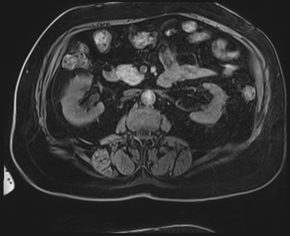 Adrenal cortical carcinoma (Radiopaedia 64017-72770 Axial T1 C+ fat sat 25).jpg