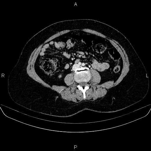 Adrenal cortical carcinoma (Radiopaedia 84882-100379 Axial C+ portal venous phase 50).jpg