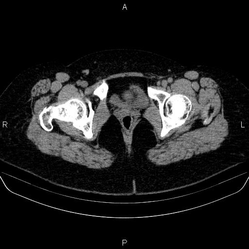 File:Adrenal cortical carcinoma (Radiopaedia 84882-100379 Axial non-contrast 95).jpg