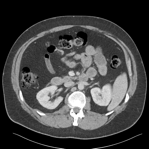 Adrenal cyst (Radiopaedia 45625-49777 Axial C+ portal venous phase 43).png