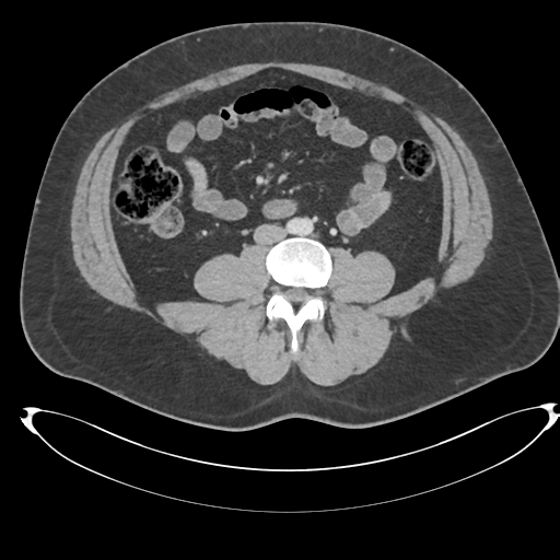File:Adrenal cyst (Radiopaedia 45625-49778 AXIAL THICK 60 sec 64).png