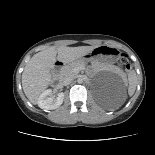 Adrenal cyst (Radiopaedia 64869-73813 Axial C+ portal venous phase 27).jpg