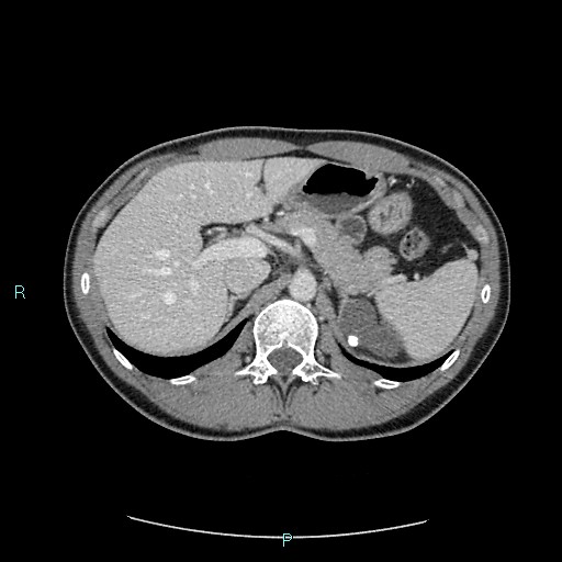 Adrenal cystic lymphangioma (Radiopaedia 83161-97534 Axial C+ portal venous phase 28).jpg