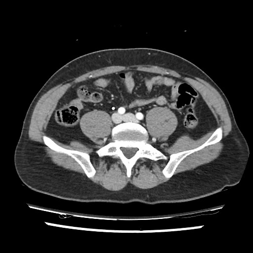 Adrenal gland trauma (Radiopaedia 81351-95078 Axial Dual bolus trauma C+ 94).jpg