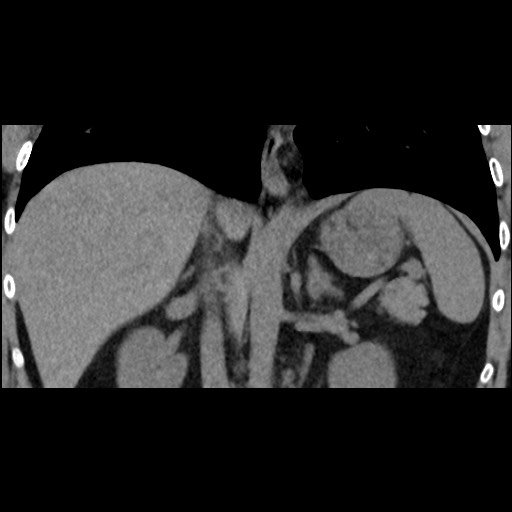 File:Adrenal gland trauma (Radiopaedia 81351-95079 Coronal non-contrast 51).jpg