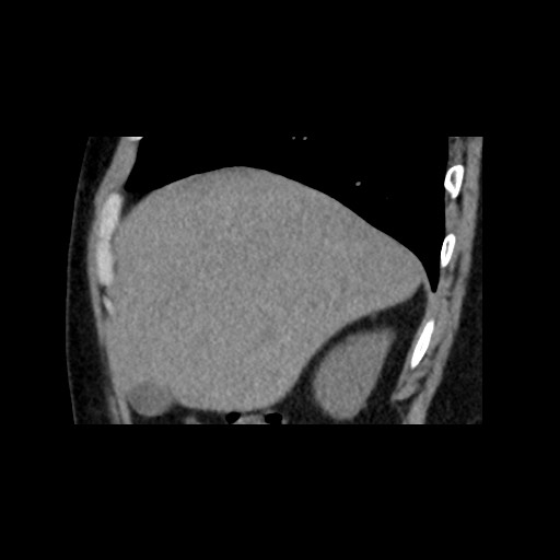 Adrenal gland trauma (Radiopaedia 81351-95079 Sagittal non-contrast 20).jpg