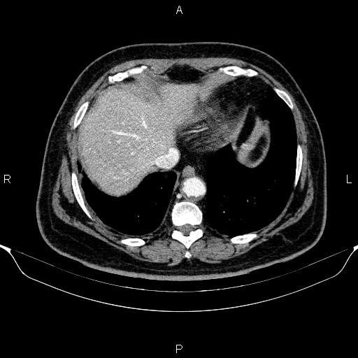Adrenal hemorrhage (Radiopaedia 62622-70916 Axial C+ portal venous phase 14).jpg