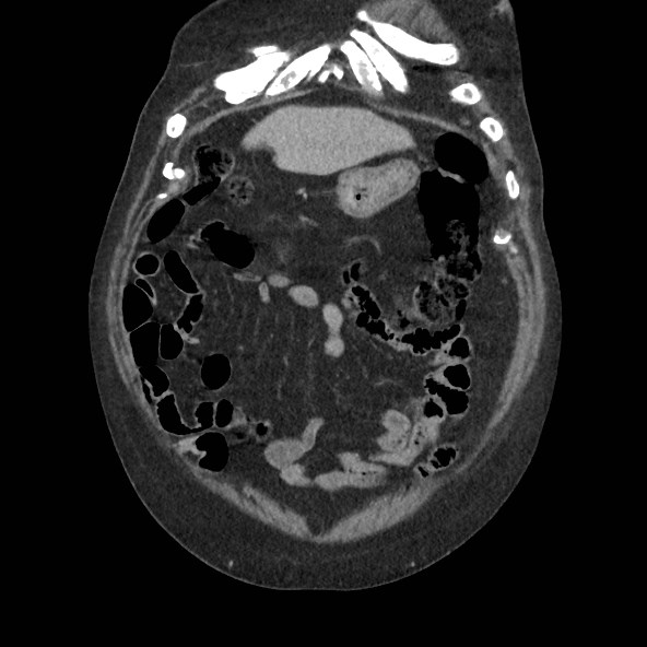 Adrenal lymphoma (Radiopaedia 84145-99415 Coronal C+ portal venous phase 12).jpg