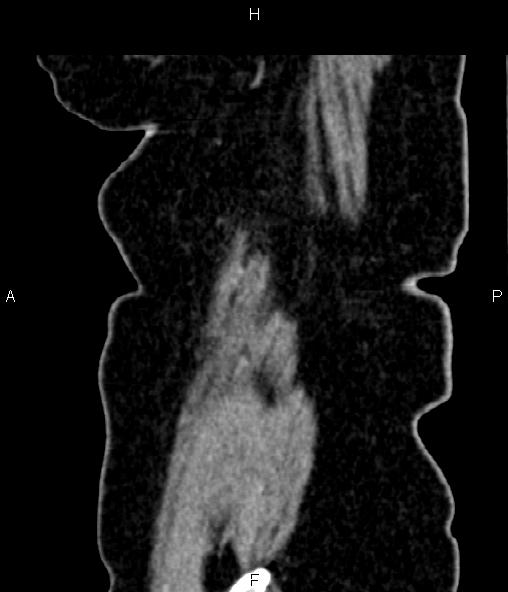 Adrenal myelolipoma (Radiopaedia 82742-96986 Sagittal renal cortical phase 102).jpg