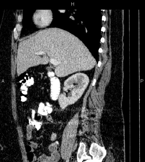 Adrenal myelolipoma (Radiopaedia 84319-99617 Sagittal renal cortical phase 32).jpg