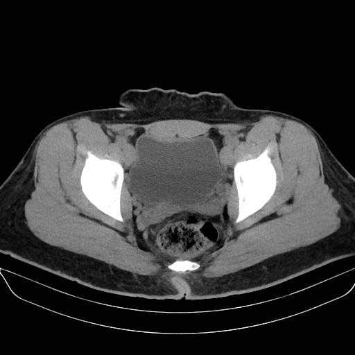 Adrenal myelolipoma - bilateral (Radiopaedia 74805-85810 Axial non-contrast 76).jpg