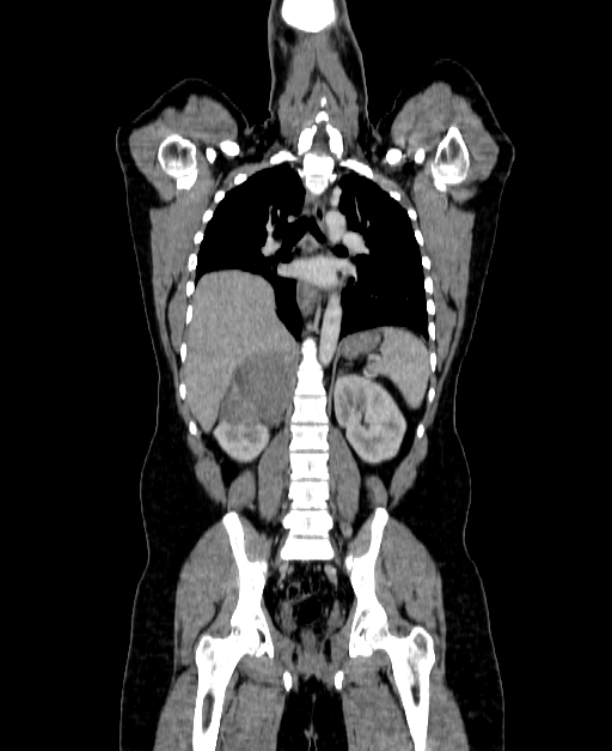 Adrenocortical carcinoma (Radiopaedia 80134-93438 Coronal C+ portal venous phase 108).jpg