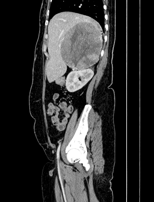 Adrenocortical carcinoma (Radiopaedia 87281-103569 Sagittal C+ portal venous phase 67).jpg