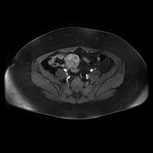 File:Adult granulosa cell tumor of the ovary (Radiopaedia 64991-73953 axial-T1 Fat sat post-contrast dynamic 35).jpg