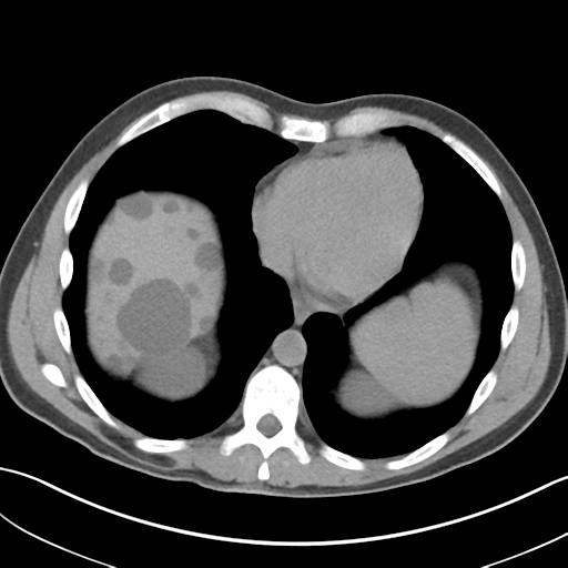 File:Adult polycystic kidney disease (Radiopaedia 47866-52626 Axial non-contrast 5).png