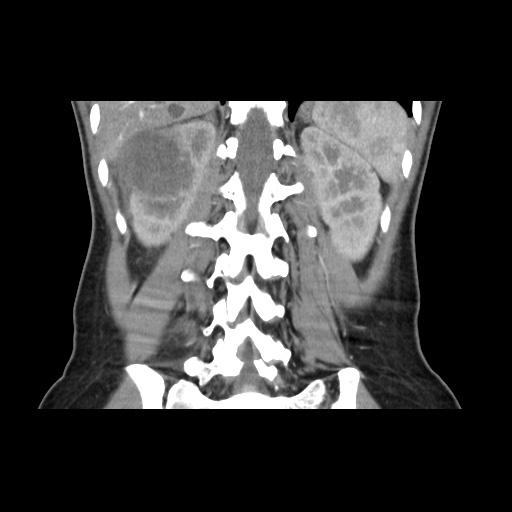 File:Adult polycystic kidney disease (Radiopaedia 48845-53876 Coronal renal cortical phase 29).jpg