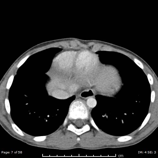 File:Agenesis of the gallbladder (Radiopaedia 55454-61905 B 7).jpg