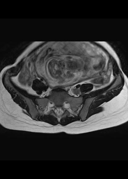 File:Aggressive angiomyxoma of the pelvis and perineum (Radiopaedia 59162-66479 Axial T2 23).jpg