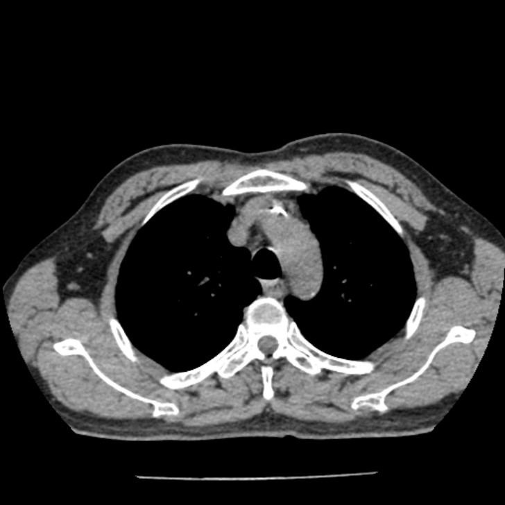 Airway foreign body in adult (Radiopaedia 85907-101779 Axial liver window 29).jpg