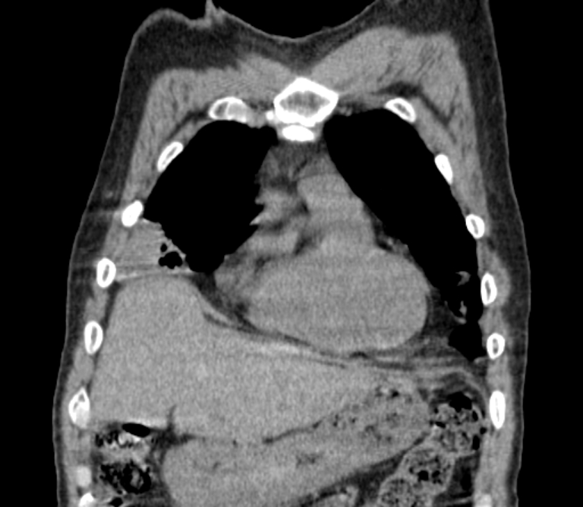 Airway foreign body in adult (Radiopaedia 85907-101779 Coronal liver window 50).jpg