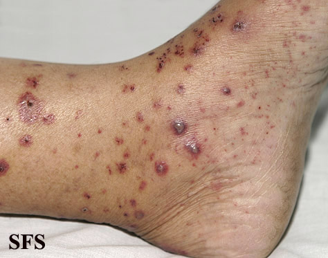 Allergic Vasculitis (Dermatology Atlas 11).jpg