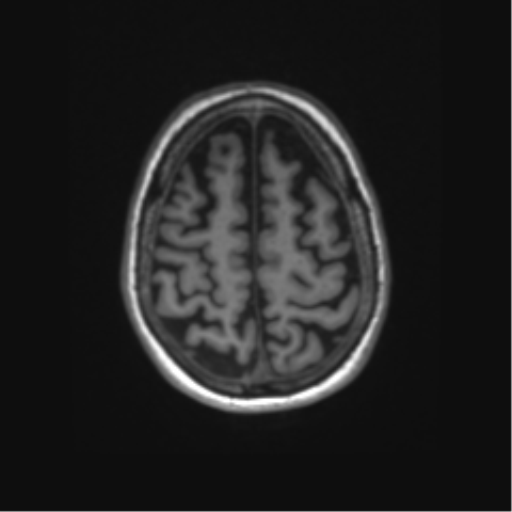 File:Alzheimer's disease (Radiopaedia 42658-45802 Axial T1 35).png