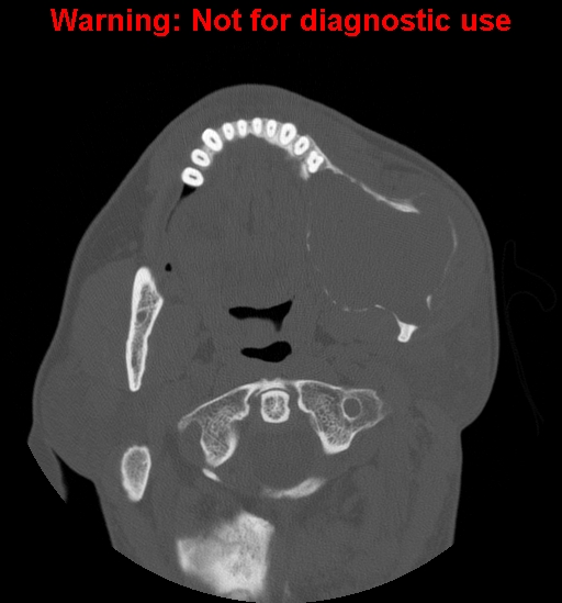 File:Ameloblastoma (Radiopaedia 13276-13280 Axial non-contrast 13).jpg