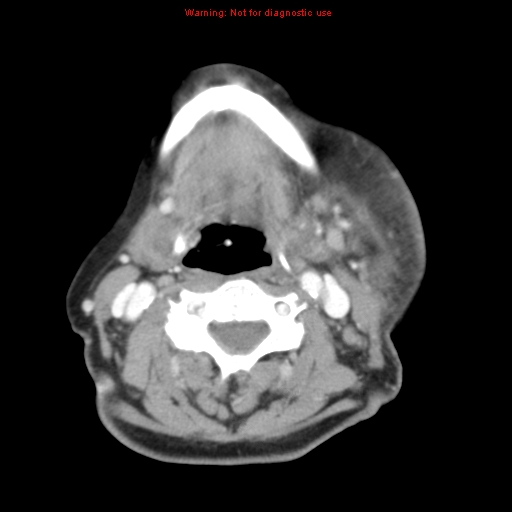 Ameloblastoma (Radiopaedia 27437-27631 A 54).jpg