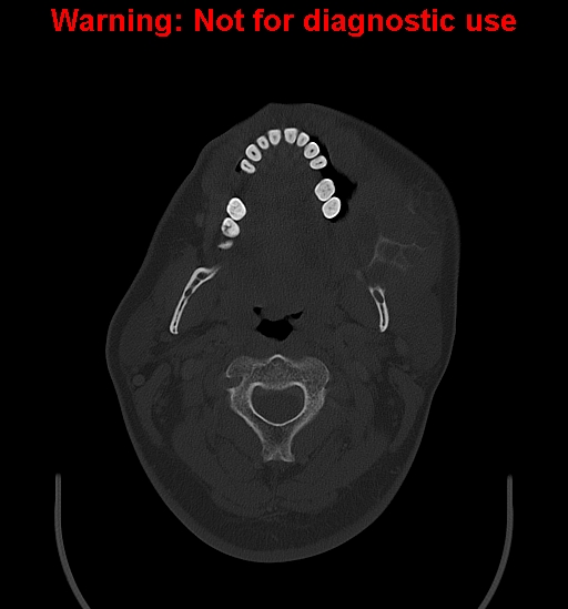 Ameloblastoma (Radiopaedia 33126-34164 Axial bone window 10).jpg