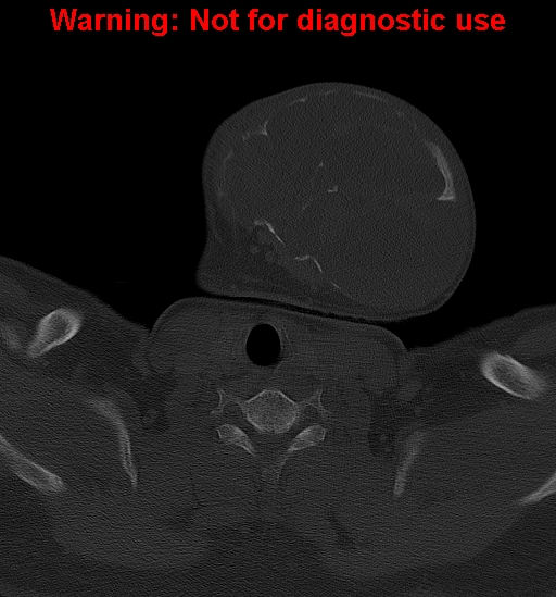 Ameloblastoma (Radiopaedia 33126-34164 Axial bone window 34).jpg