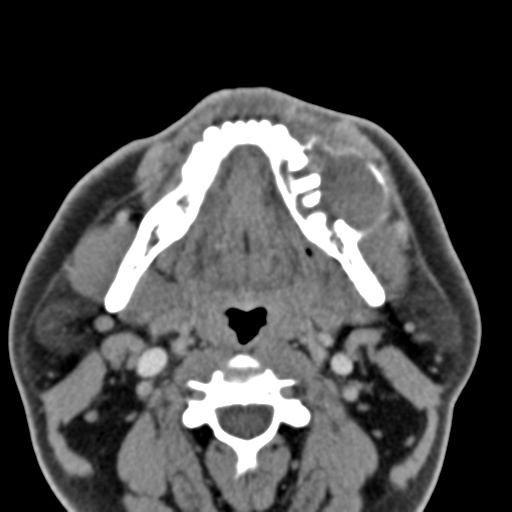 File:Ameloblastoma (Radiopaedia 33677-34806 Axial non-contrast 23).png
