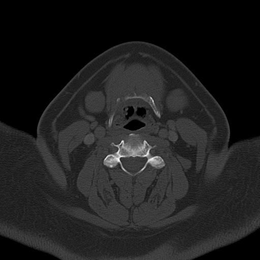 Ameloblastoma (Radiopaedia 38520-40623 Axial bone window 43).png