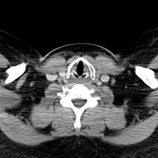 Ameloblastoma (Radiopaedia 38520-40623 Axial non-contrast 58).png