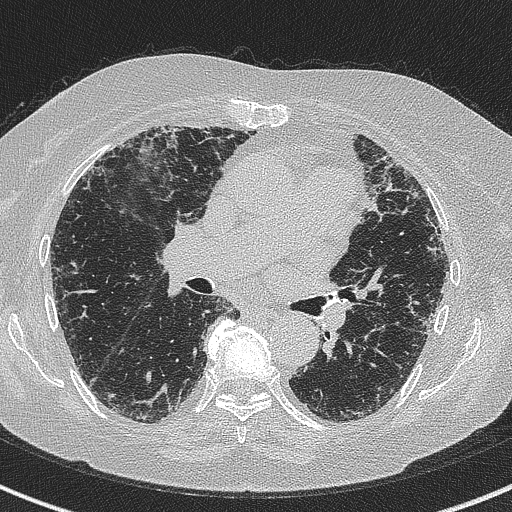 File:Amiodarone-induced pulmonary fibrosis (Radiopaedia 82355-96460 Axial lung window 34).jpg