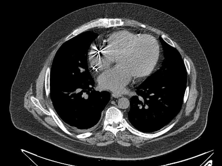 Amiodarone lung (Radiopaedia 62514-70769 Axial non-contrast 54).jpg