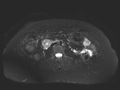 Ampullary adenocarcinoma (Radiopaedia 54765-61014 Axial T2 space-FS 50).jpg