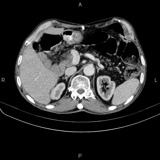 File:Ampullary adenocarcinoma (Radiopaedia 86093-102033 B 58).jpg