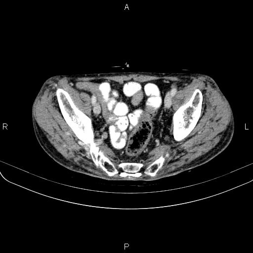 Ampullary adenocarcinoma (Radiopaedia 86093-102033 B 99).jpg