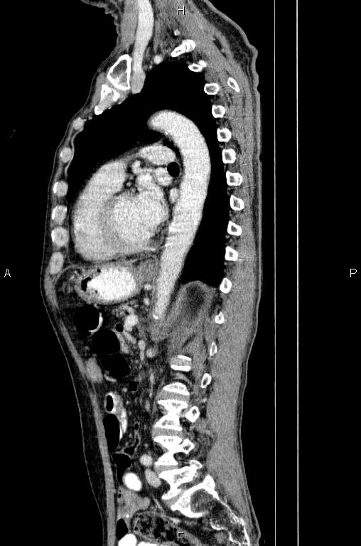 Ampullary adenocarcinoma (Radiopaedia 86093-102033 E 57).jpg