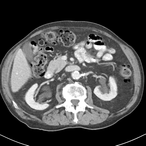 File:Amyand hernia (Radiopaedia 39300-41547 A 25).png
