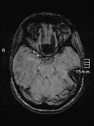 Amyotrophic lateral sclerosis (Radiopaedia 70821-81017 Axial SWI 15).jpg