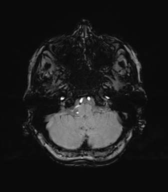 Anaplastic astrocytoma (Radiopaedia 86943-103160 Axial SWI 19).png