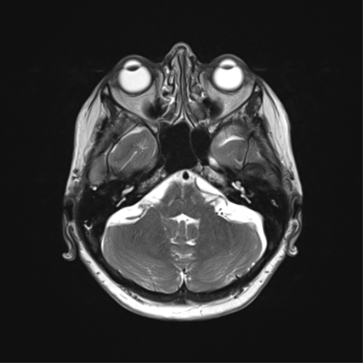 File:Anaplastic astrocytoma (Radiopaedia 86943-103160 Axial T2 11).png