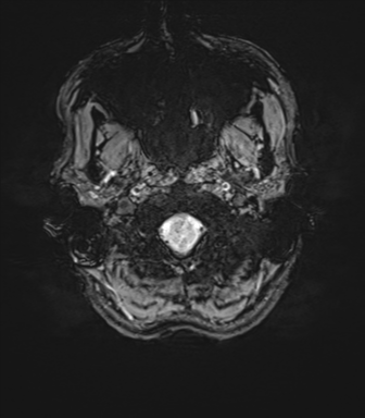 File:Anaplastic astrocytoma IDH mutant (Radiopaedia 50046-55341 Axial SWI 7).png